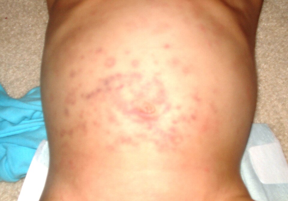 Widespread rash on a child's torso