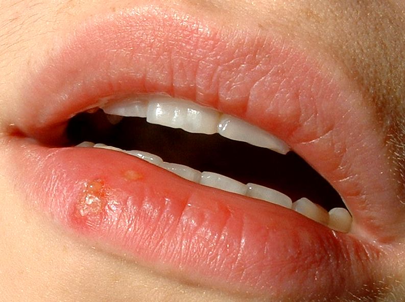 Blister cluster on the lower lip