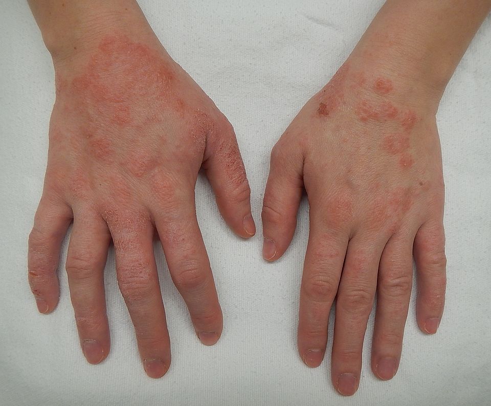 Red, dry, irritated patches on the backs of both hands