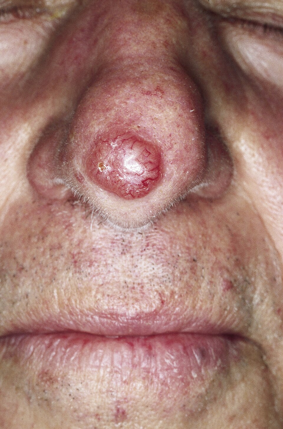Pink, pearly, ulcerated bump on the tip of the nose