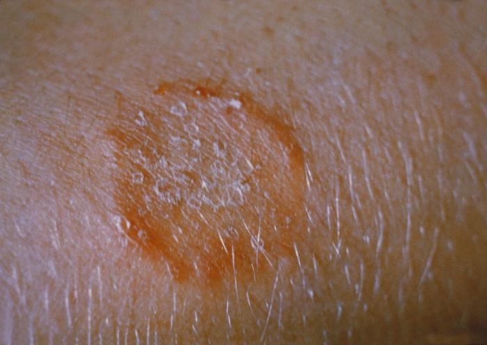 Round, scaly, ring-shaped patch on the arm