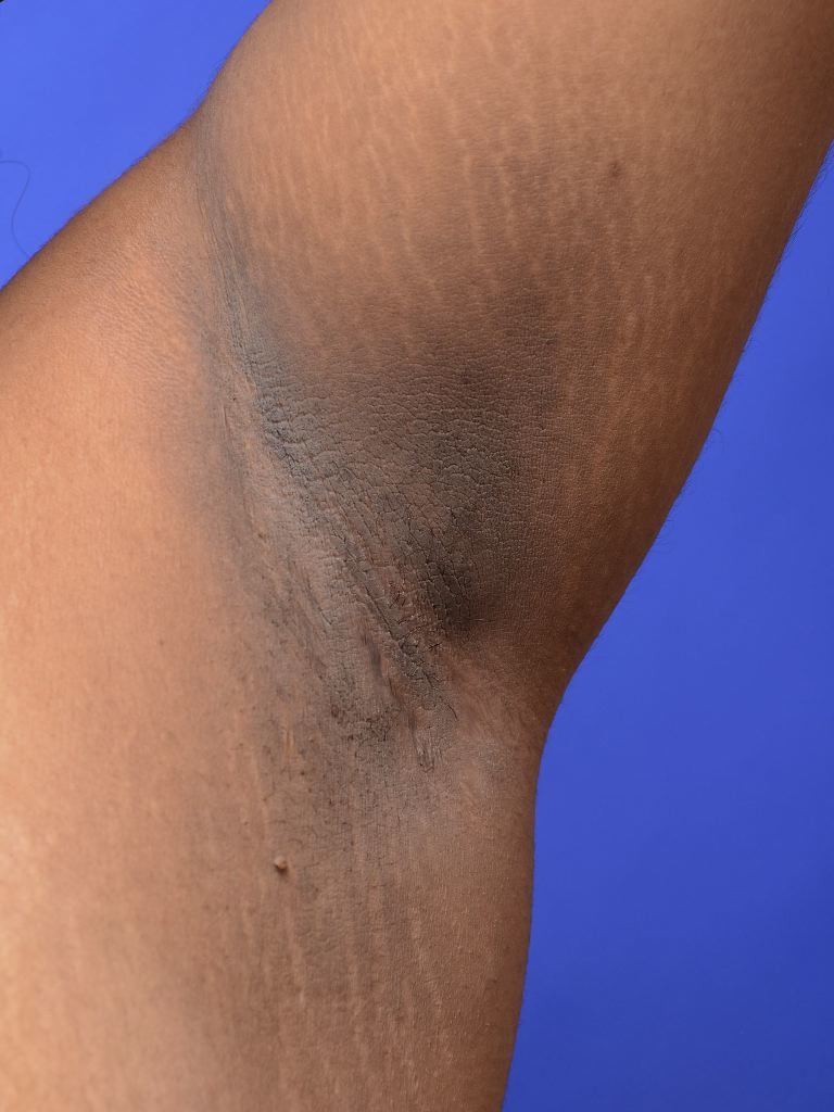 Darker, thickened skin in the armpit